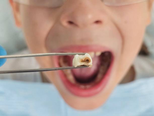 Best Emergency Tooth Extraction  in Walcott, IA